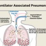 ventilator-associated bacterial pneumonia