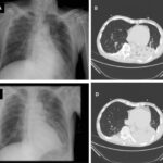 ventilator-associated pneumonia due to acinetobacter