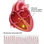 ventricular arrhythmias