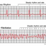 ventricular fibrillation