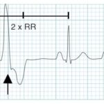 ventricular premature beats