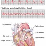 ventricular tachycardia