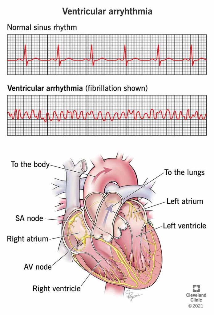 ventricular tachycardia