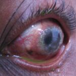 vernal keratitis