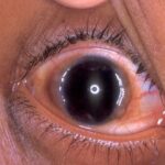 vernal keratoconjunctivitis