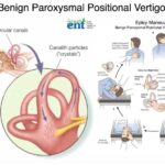 vertigo causes