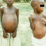 visceral leishmaniasis