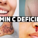 vitamin c deficiency