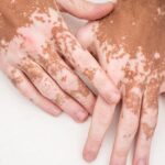 vitiligo