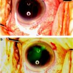 vitrectomy adjunct to enhance visualization