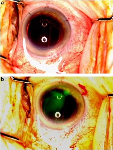 vitrectomy adjunct to enhance visualization