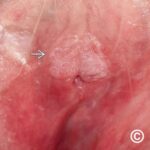 vulvar intraepithelial neoplasia