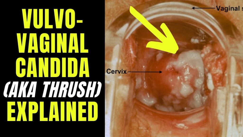 vulvovaginal candidiasis