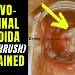 vulvovaginal candidiasis