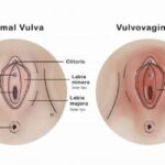 vulvovaginitis