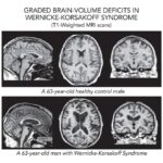 wernicke-korsakoff syndrome