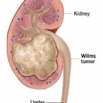 wilms' tumor