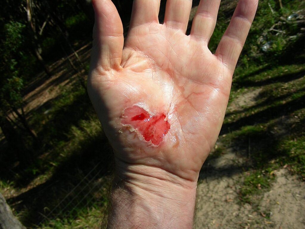 wound