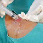 wound irrigation