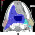 xerostomia secondary to radiation therapy