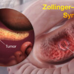 zollinger-ellison syndrome