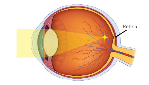 Myopia