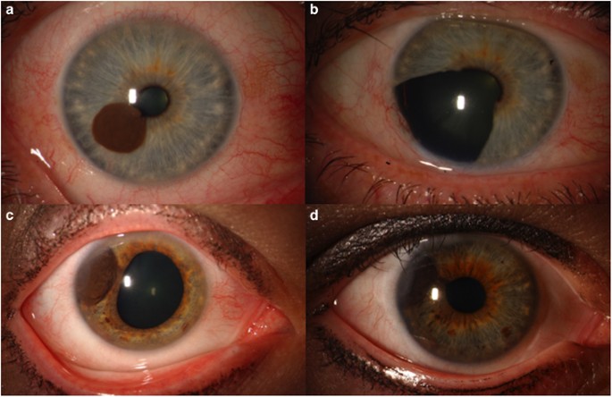 Ocular Melanoma