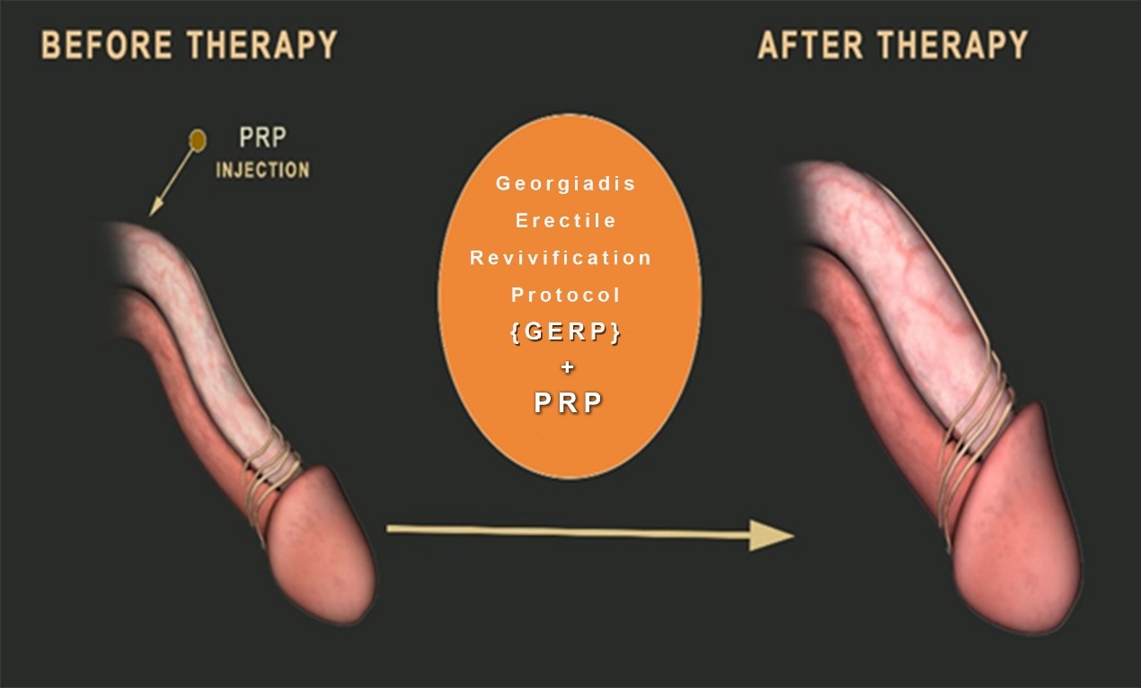 Penile PRP Injection