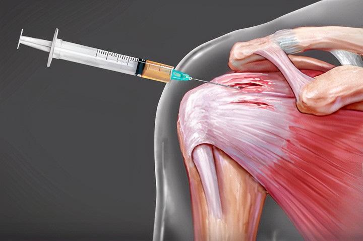 Shoulder PRP Injection